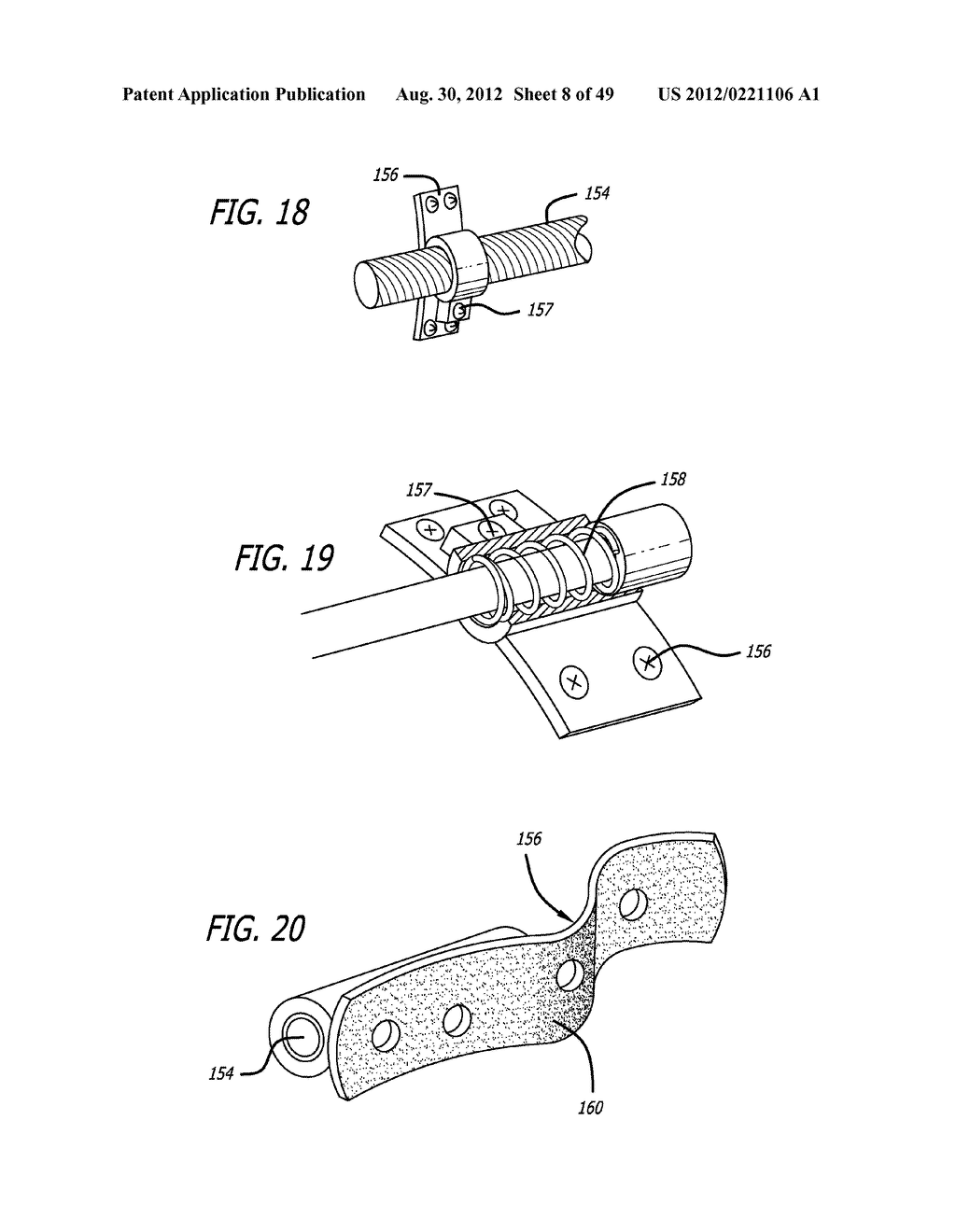 Extra-Articular Implantable Load Sharing Systems - diagram, schematic, and image 09