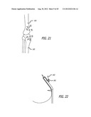 Extra-Articular Implantable Load Sharing Systems diagram and image