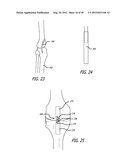 Extra-Articular Implantable Load Sharing Systems diagram and image