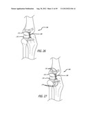 Extra-Articular Implantable Load Sharing Systems diagram and image