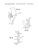 Extra-Articular Implantable Load Sharing Systems diagram and image