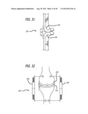 Extra-Articular Implantable Load Sharing Systems diagram and image