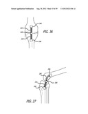 Extra-Articular Implantable Load Sharing Systems diagram and image