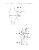 Extra-Articular Implantable Load Sharing Systems diagram and image