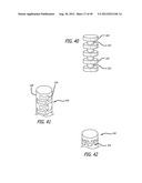 Extra-Articular Implantable Load Sharing Systems diagram and image