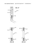 Extra-Articular Implantable Load Sharing Systems diagram and image