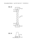 Extra-Articular Implantable Load Sharing Systems diagram and image