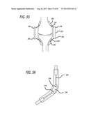 Extra-Articular Implantable Load Sharing Systems diagram and image