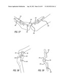 Extra-Articular Implantable Load Sharing Systems diagram and image