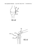 Extra-Articular Implantable Load Sharing Systems diagram and image