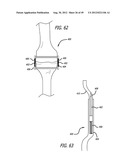 Extra-Articular Implantable Load Sharing Systems diagram and image