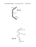 Extra-Articular Implantable Load Sharing Systems diagram and image