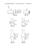 Extra-Articular Implantable Load Sharing Systems diagram and image