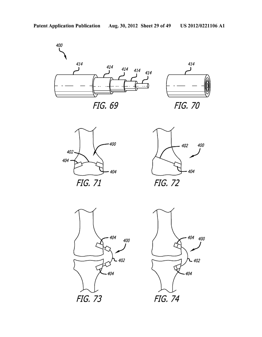 Extra-Articular Implantable Load Sharing Systems - diagram, schematic, and image 30