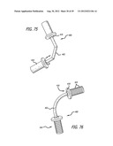 Extra-Articular Implantable Load Sharing Systems diagram and image