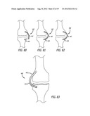 Extra-Articular Implantable Load Sharing Systems diagram and image