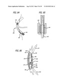 Extra-Articular Implantable Load Sharing Systems diagram and image