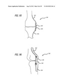 Extra-Articular Implantable Load Sharing Systems diagram and image