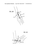 Extra-Articular Implantable Load Sharing Systems diagram and image