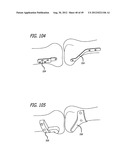 Extra-Articular Implantable Load Sharing Systems diagram and image