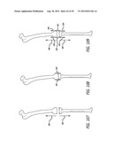 Extra-Articular Implantable Load Sharing Systems diagram and image