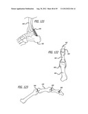 Extra-Articular Implantable Load Sharing Systems diagram and image