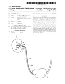 URETERAL STENT diagram and image