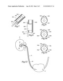 URETERAL STENT diagram and image