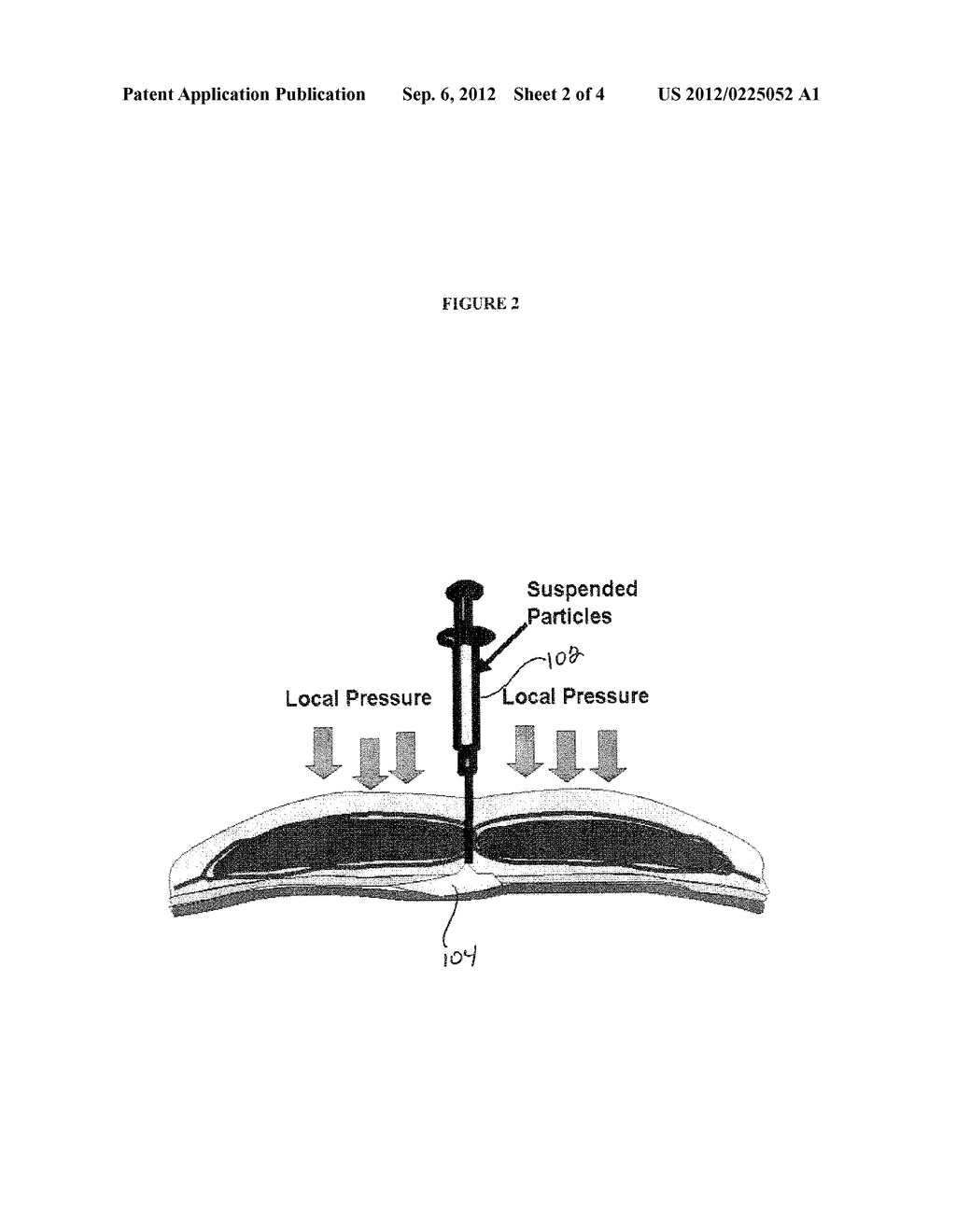 COMPOSITION AND METHOD FOR TREATING TISSUE DEFECTS - diagram, schematic, and image 03