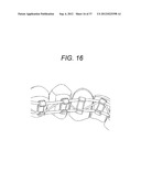 Orthodontic Archwire And Bracket System diagram and image