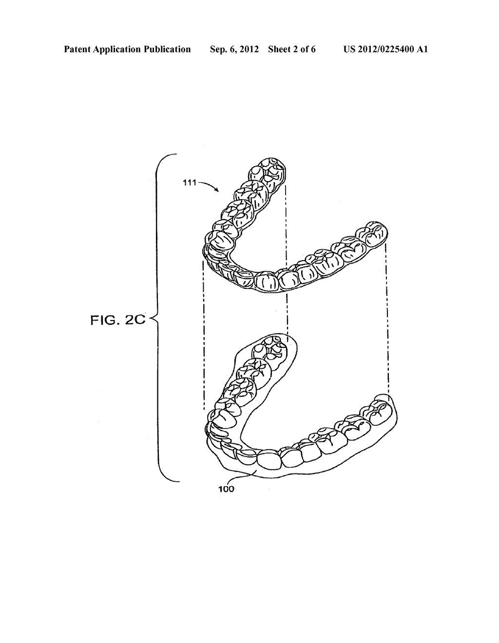 SYSTEM AND METHOD FOR POSITIONING TEETH - diagram, schematic, and image 03