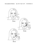 DEVICES AND METHODS FOR SKIN TIGHTENING diagram and image