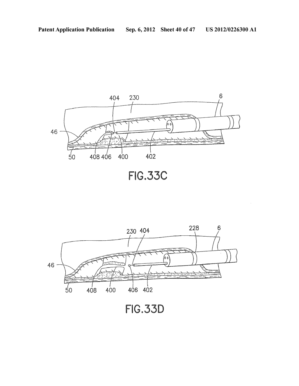 Methods and Systems for Performing Submucosal Medical Procedures - diagram, schematic, and image 41