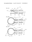 Methods and Systems for Performing Submucosal Medical Procedures diagram and image