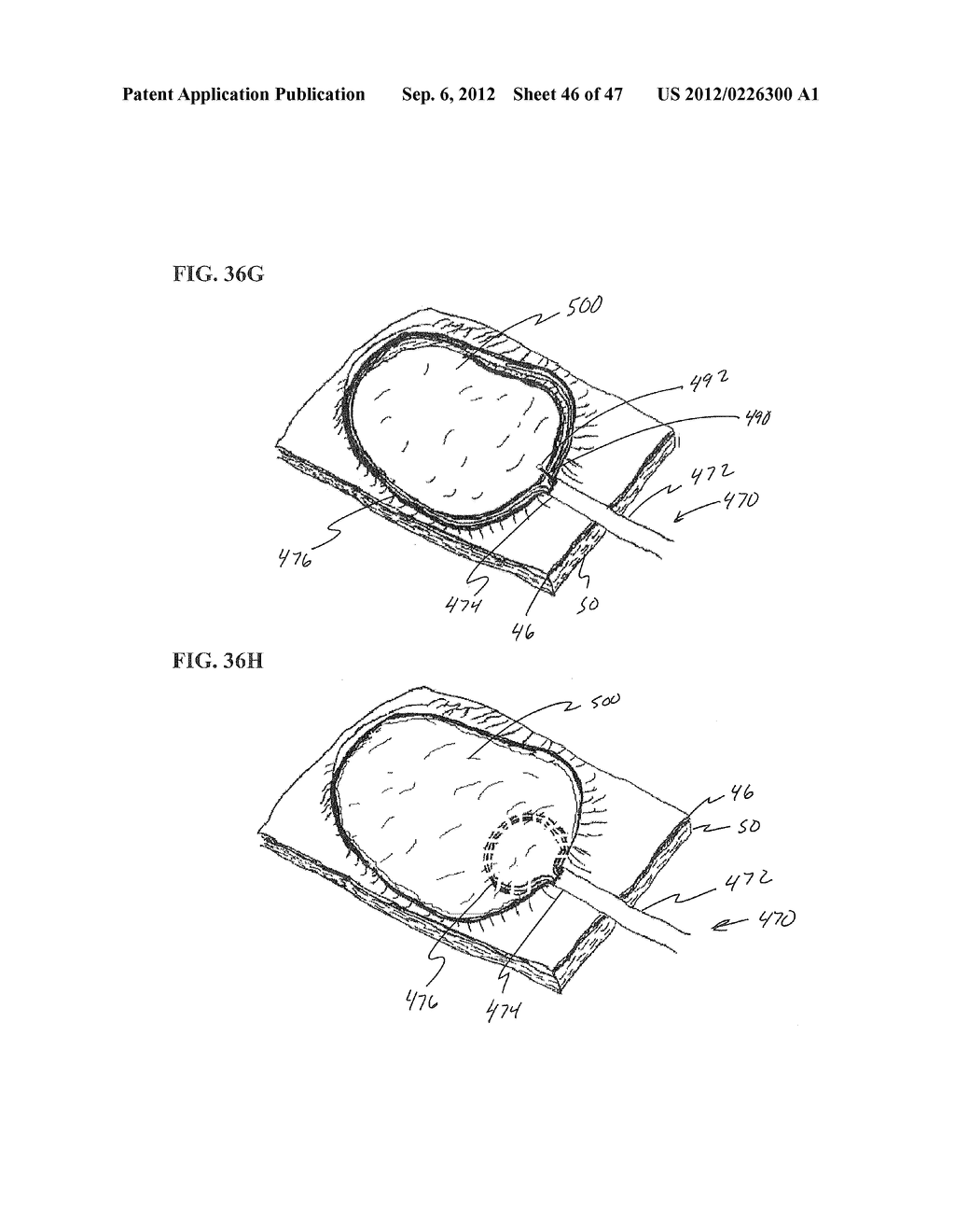 Methods and Systems for Performing Submucosal Medical Procedures - diagram, schematic, and image 47