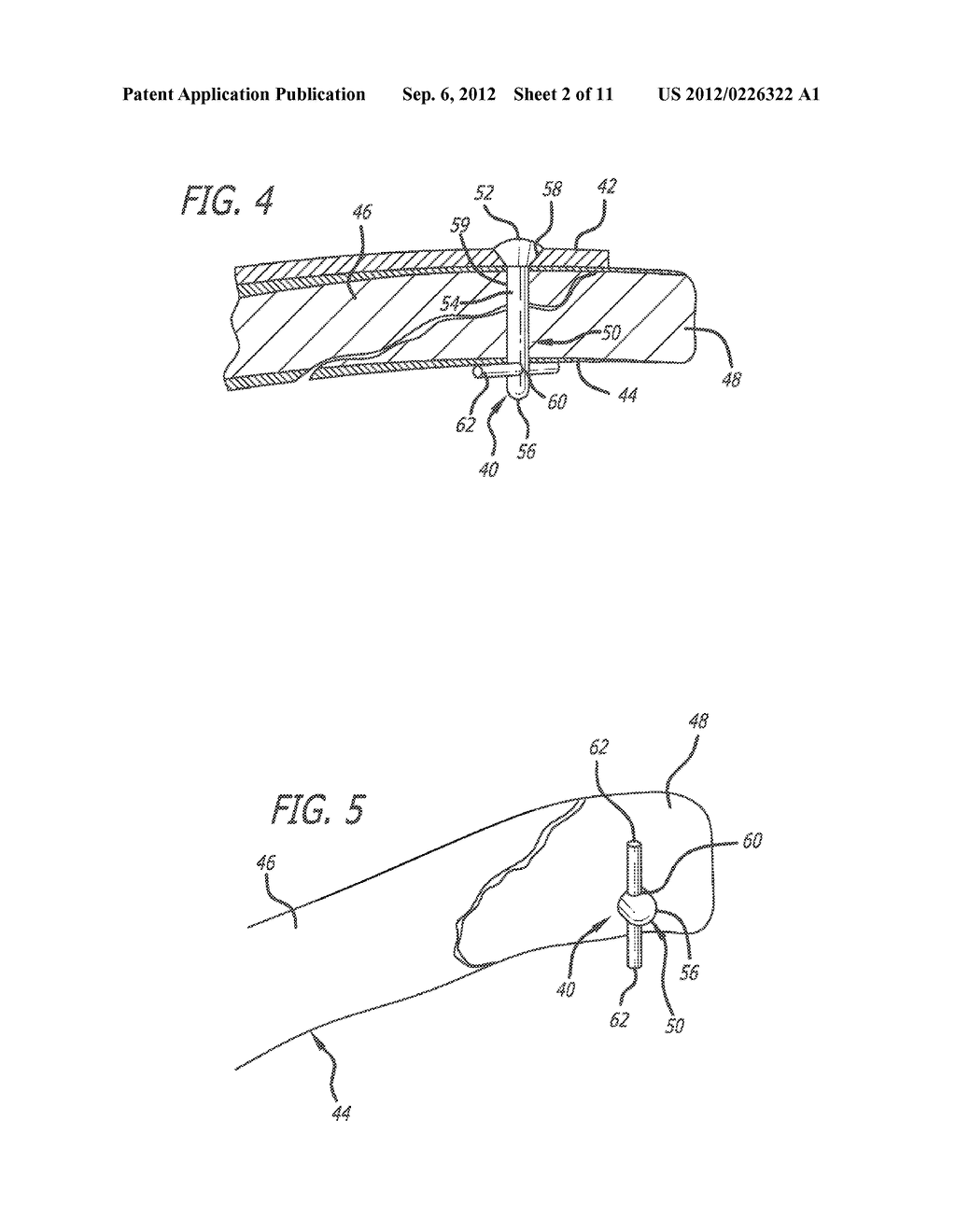 EXTRA-MEDULLARY CORTICAL BUTTRESS FIXATION DEVICE AND METHOD OF USE     ASSOCIATED THEREWITH - diagram, schematic, and image 03