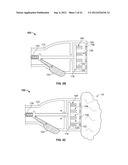 METHODS AND DEVICES FOR TREATING TISSUE diagram and image