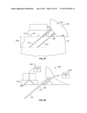 METHODS AND DEVICES FOR TREATING TISSUE diagram and image