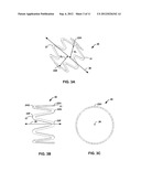 Stent with Reduced Profile diagram and image