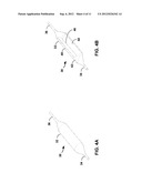 Stent with Reduced Profile diagram and image