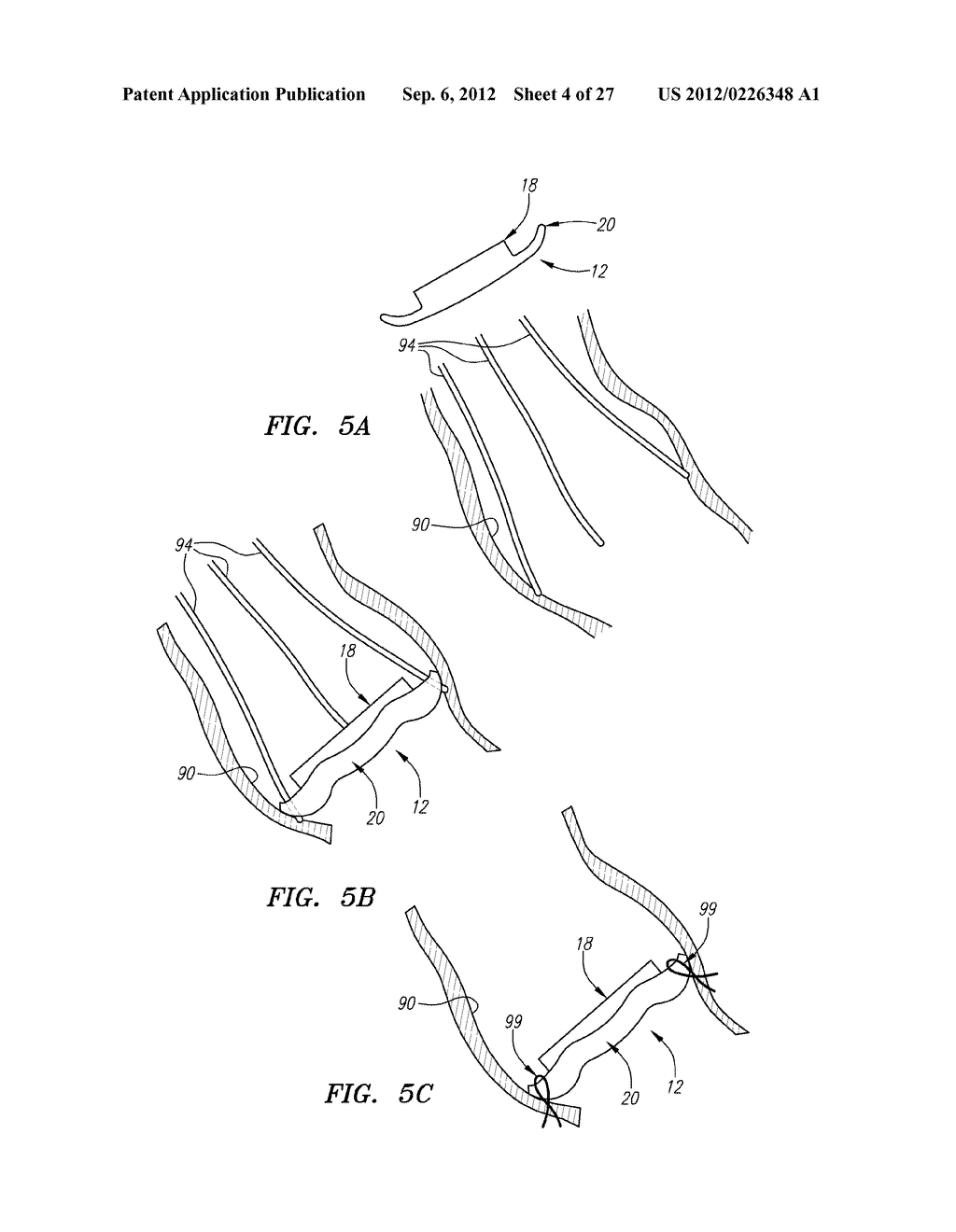 Conformable Prostheses For Implanting Two-Piece Heart Valves and Methods     for Using Them - diagram, schematic, and image 05