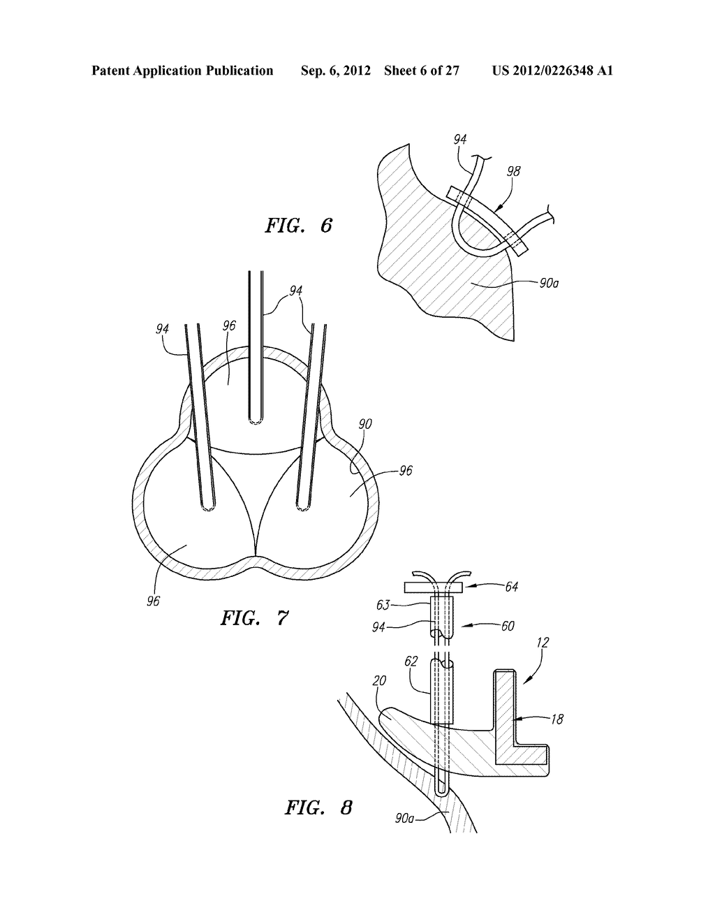 Conformable Prostheses For Implanting Two-Piece Heart Valves and Methods     for Using Them - diagram, schematic, and image 07