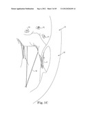 Mitral Valve Repair diagram and image