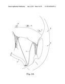 Mitral Valve Repair diagram and image