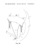 Mitral Valve Repair diagram and image