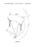 Mitral Valve Repair diagram and image