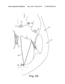 Mitral Valve Repair diagram and image