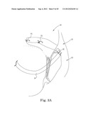 Mitral Valve Repair diagram and image