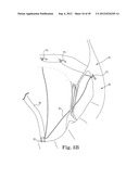 Mitral Valve Repair diagram and image