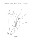 Mitral Valve Repair diagram and image